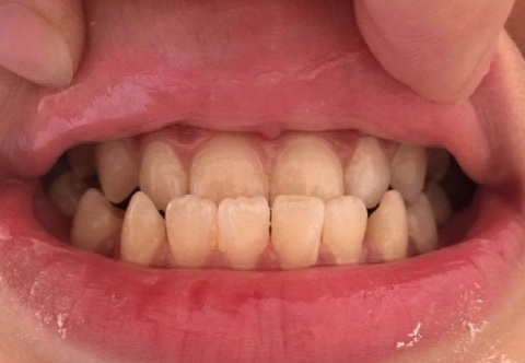 Thời gian niềng răng móm mất bao lâu? Chi phí bao nhiêu